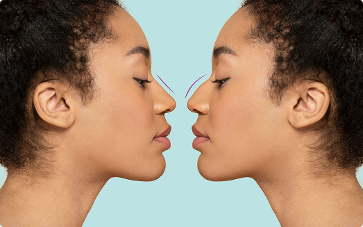 Say goodbye to your nasal insecurities:Do you feel self-conscious about a bump, drooping tip, or wide nostrils?  Rhinoplasty helps reshape your nose to better suit your facial structure—giving you a look you’ll love seeing in the mirror.