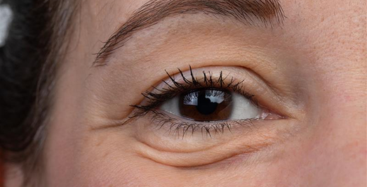 under eye bags removal