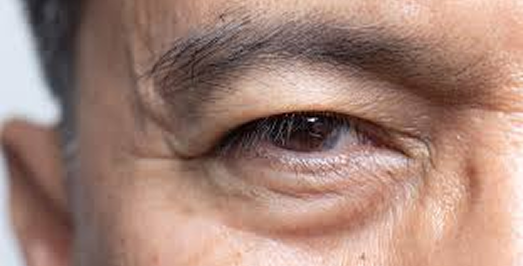 under eye bags removal