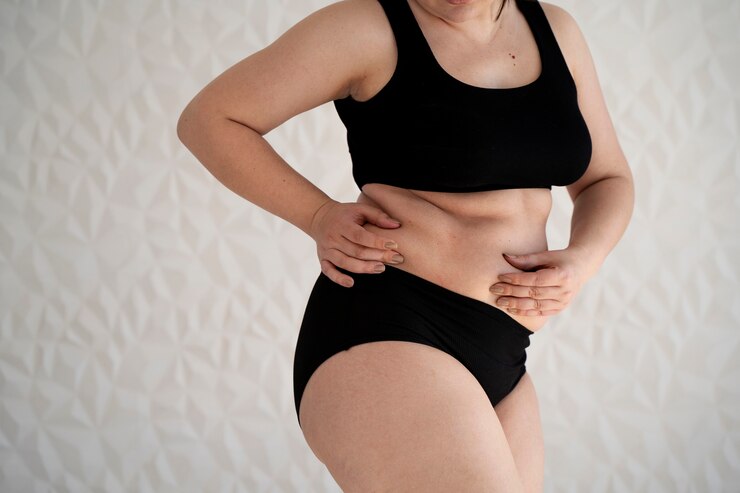 Liposuction Surgery - Karishma Cosmetic Clinic