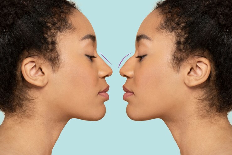 Rhinoplasty Surgery - Karishma Cosmetic Clinic