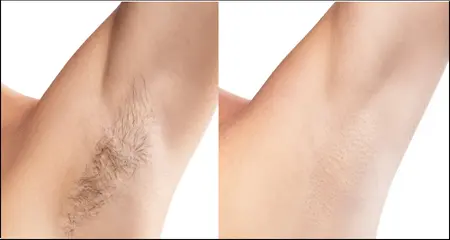 laser hair removal treatment- before- after- armpits