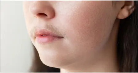 upper lips - Laser hair removal treatment - Karishma Cosmetic Clinic 