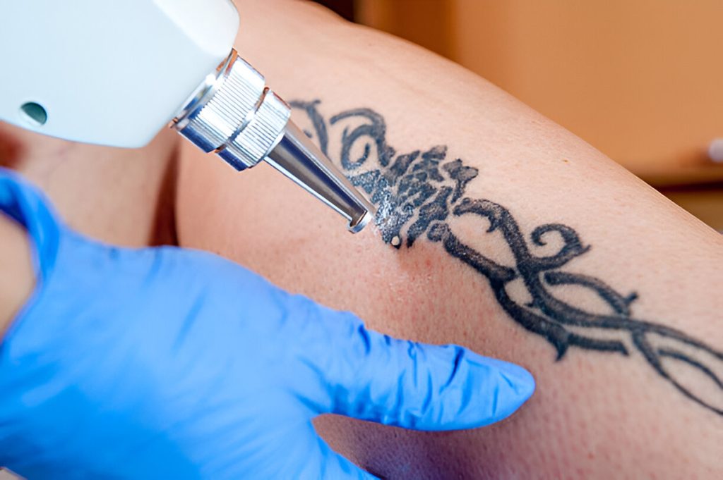 Can Tattoos get Permanently removed?