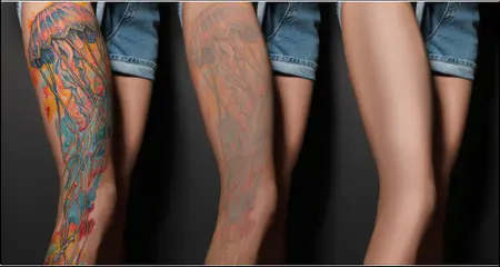 Permanent Tattoo Removal - before and after