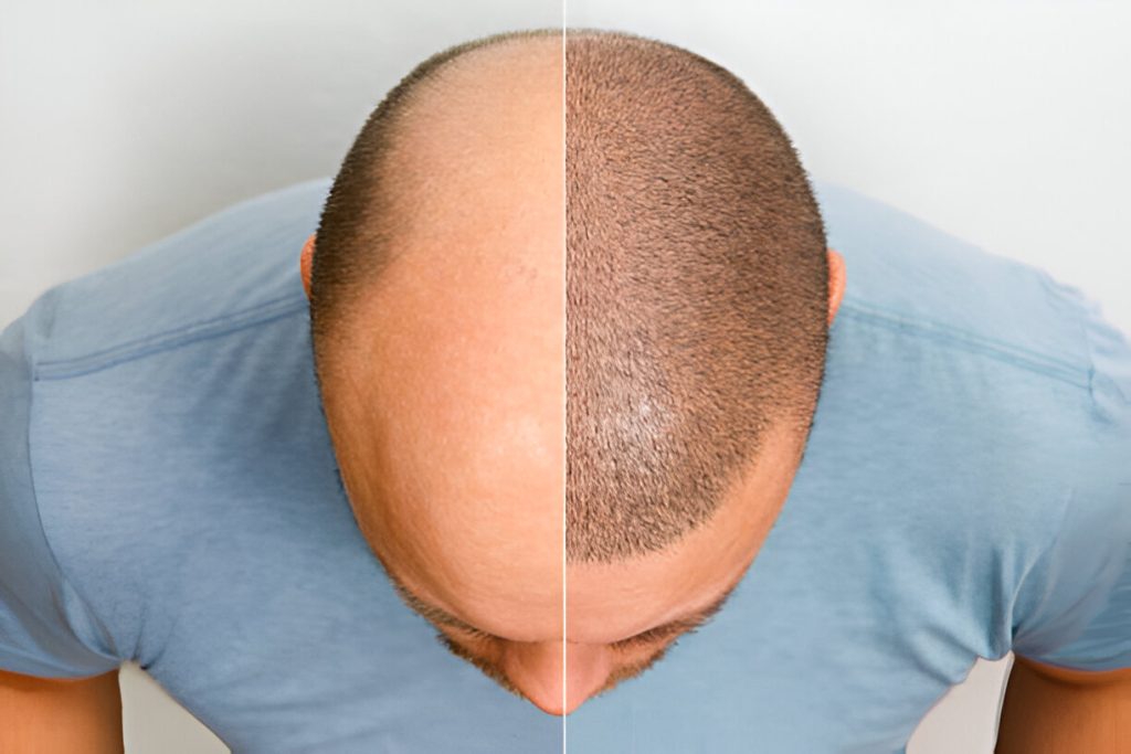 Hair Transplant - Karishma Cosmetic Clinic
