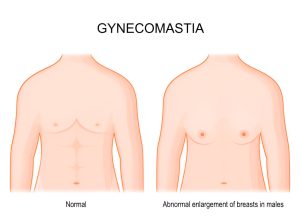 Gynecomastia vs Fat