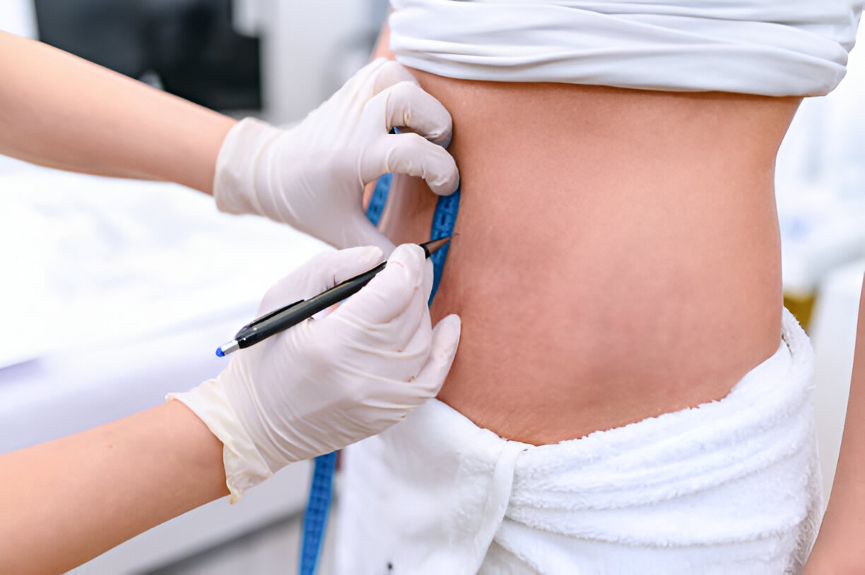 Vaser Liposuction Treatment