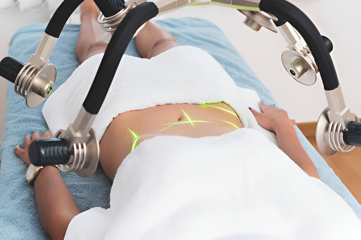 Laser Lipo Treatment