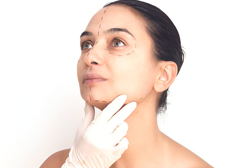 1 Week Post op Deep Plane Facelift Scars