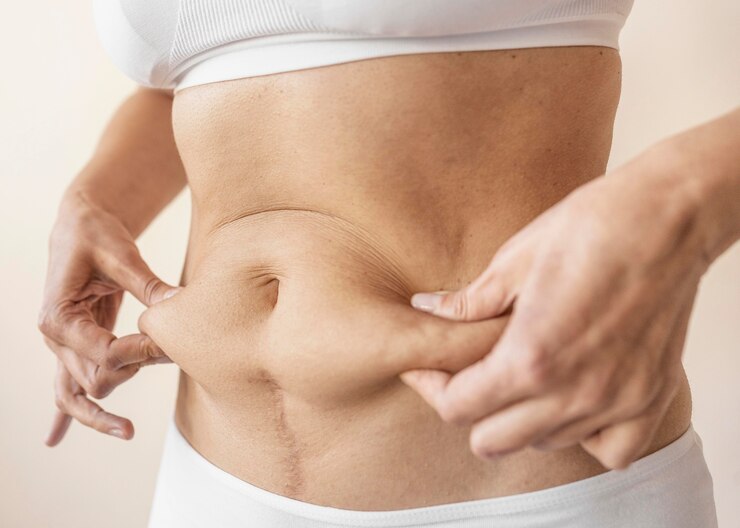 Tummy Tuck vs Liposuction Which Is Better
