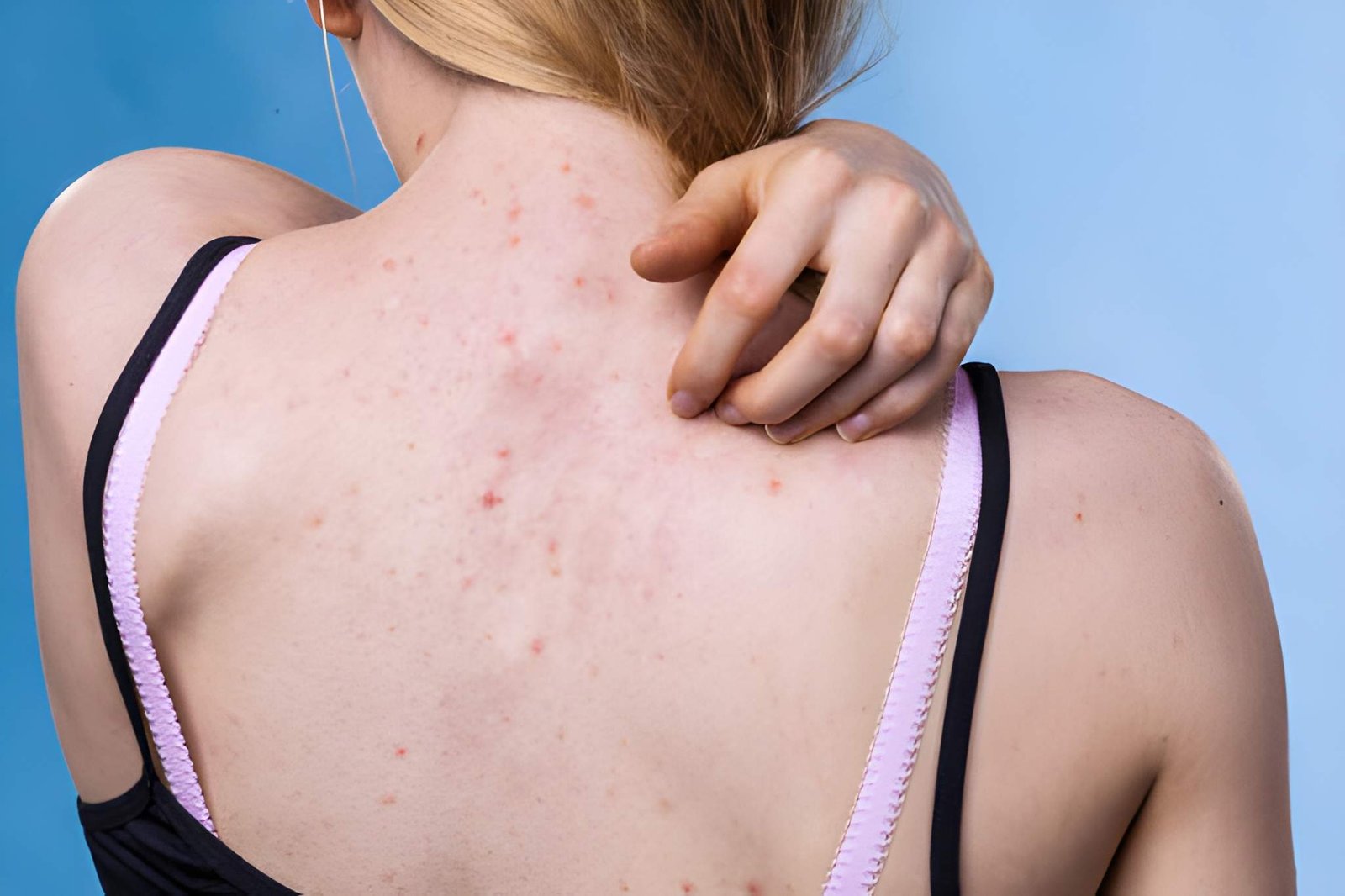 How to Get Rid of Back Acne: Causes, Treatments, and Prevention Tips