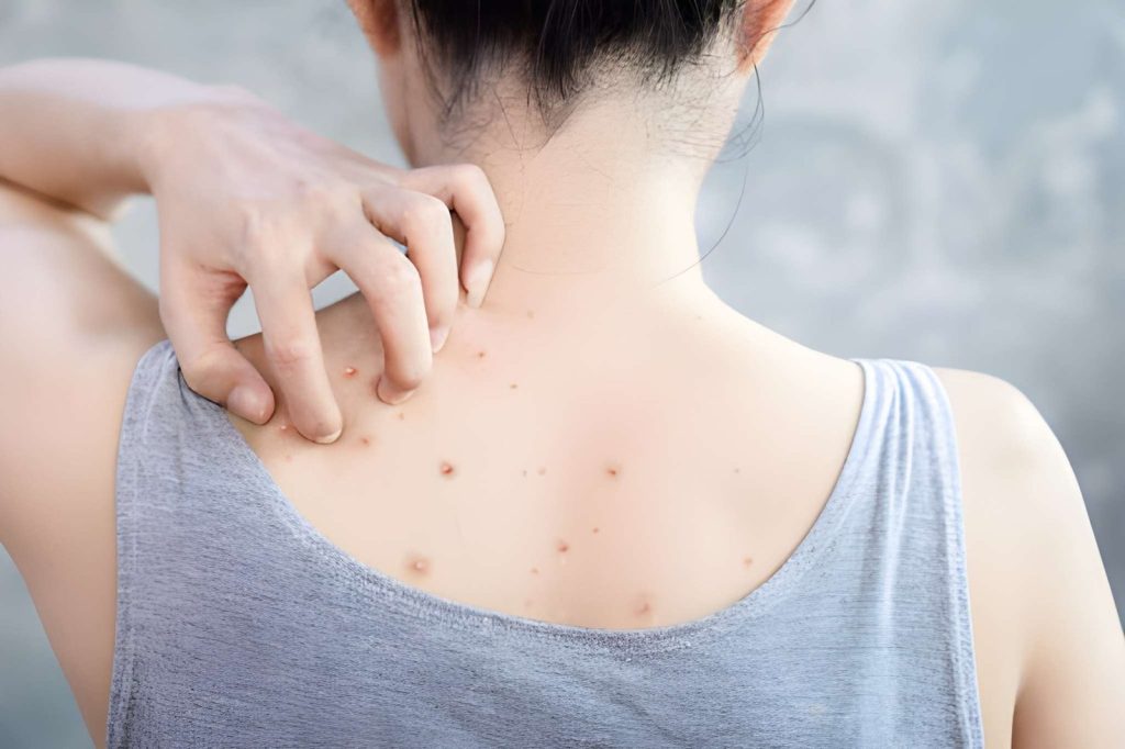 How To Get Rid Of Back Acne